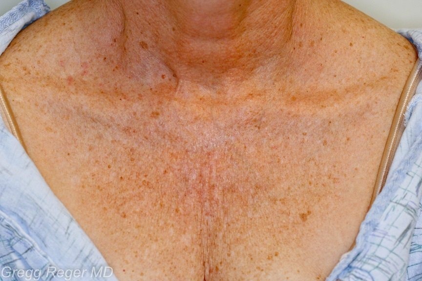 White Bumps On Chest After Sun Exposure