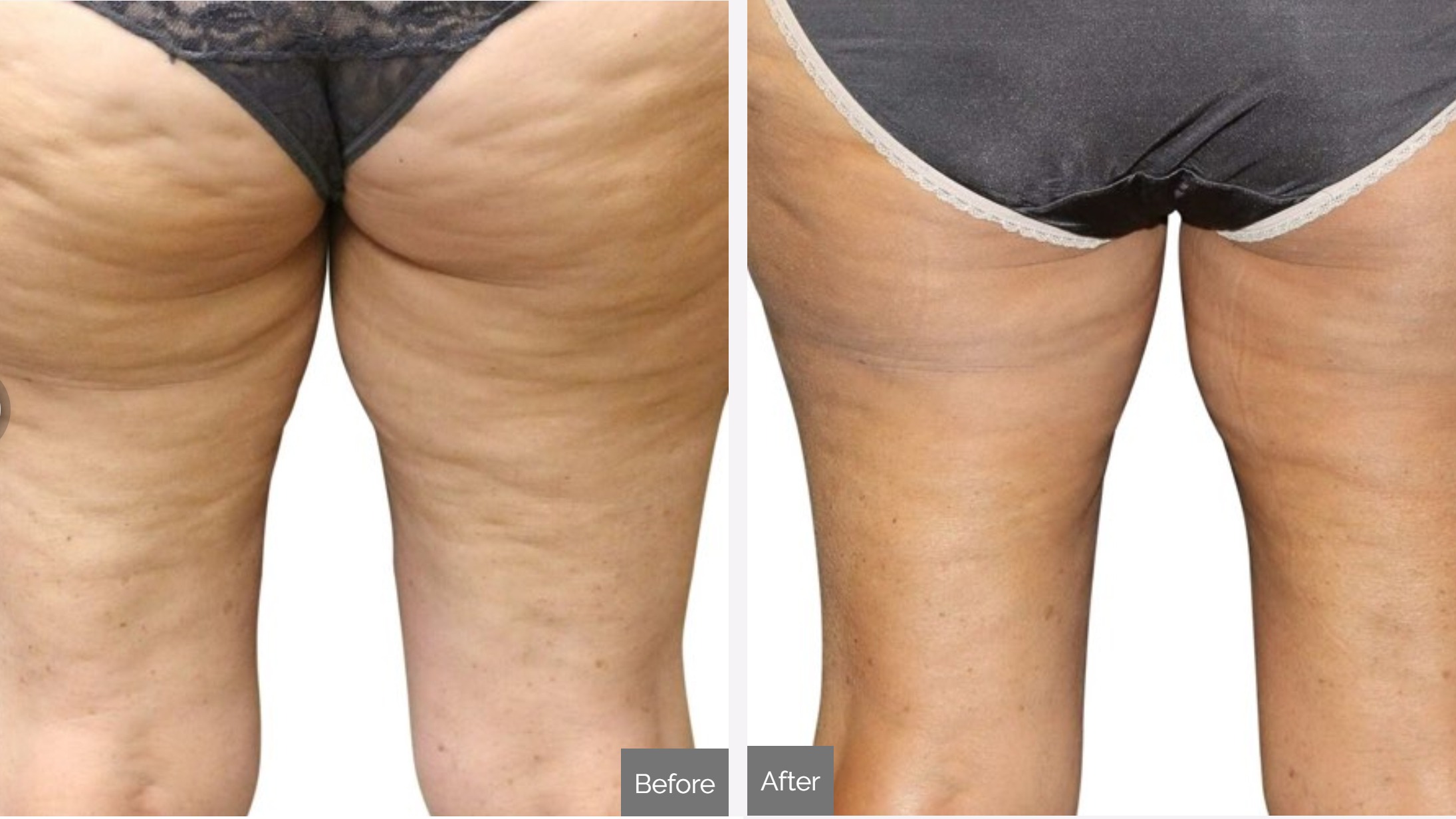 Venus RF Body Contouring  Brockville MediSpa Cosmetic & Skin Clinic