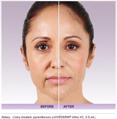 4 Easy Facts About Restylane Filler Injections - Refine Facial Plastic Surgery Described thumbnail