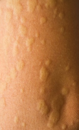 Cold Urticaria