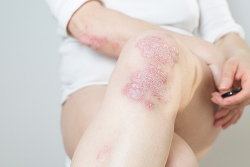 Psoriasis Treatments | The Woodlands Texas Skin Specialist