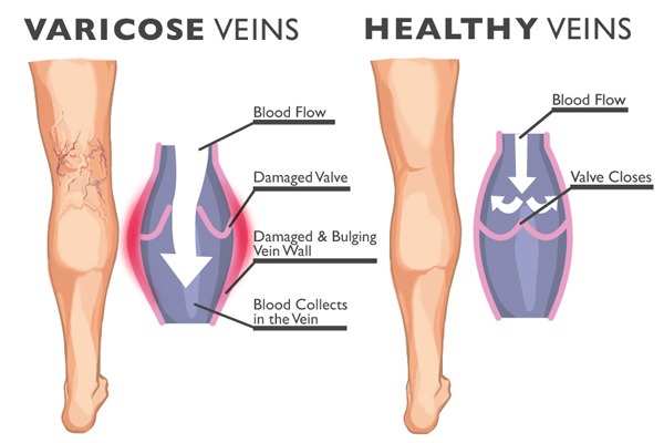 Spider Veins  Spider Vein Treatment Houston TX