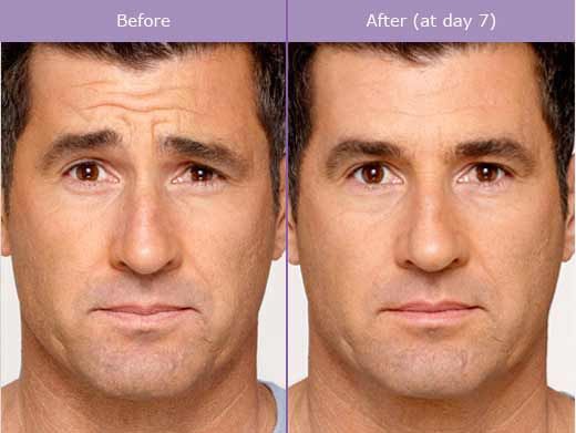 botox-injection-before-after-photos